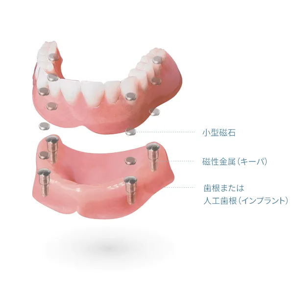 マグネットデンチャー